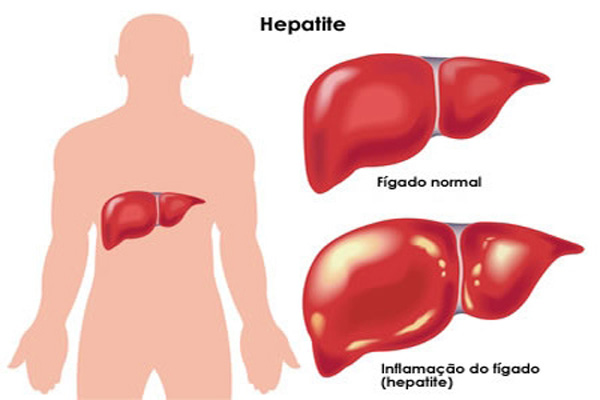 Você conhece a Hepatite C?